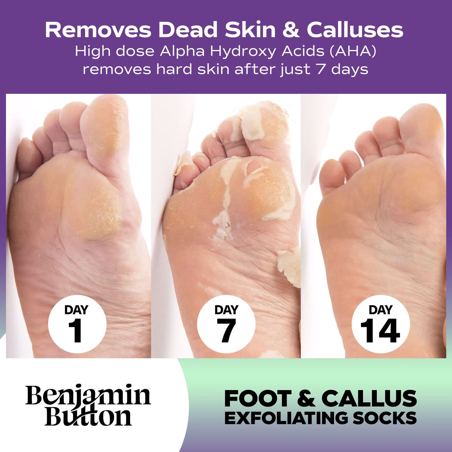 Before-and-after comparison of foot exfoliation with Benjamin Button foot and callus exfoliating socks, showing removal of dead skin and calluses over 14 days.