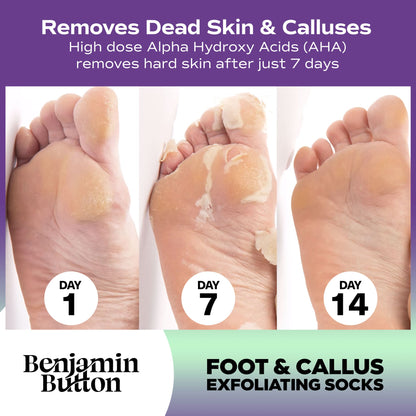 Before-and-after comparison of foot exfoliation with Benjamin Button foot and callus exfoliating socks, showing removal of dead skin and calluses over 14 days.